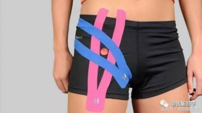 ​腹股沟疼痛 缓解腹股沟疼痛，瑜伽来帮忙！