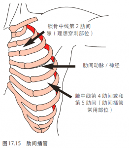 ​气胸治疗 气胸的治疗策略有哪些？一文带你了解